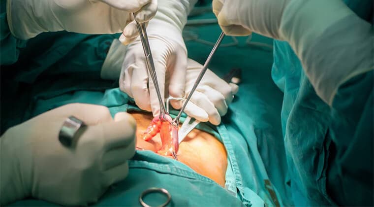 Cirugía de apendicitis (apendicectomía)