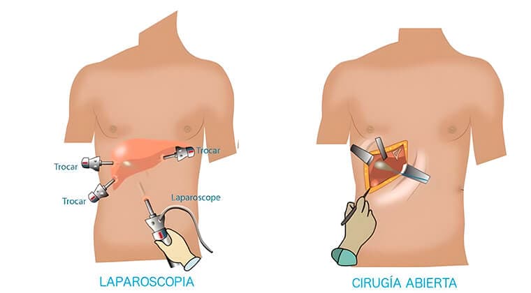 Cirugía de vesícula biliar (Colecistectomía laparoscópica o abierta)