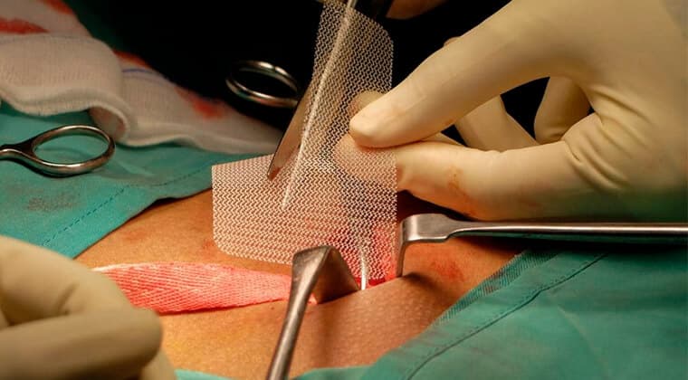 Reparación de hernias (inguinal, umbilical, hiatal, etc.)